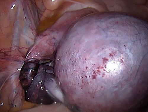 Как выглядит перекрут яичника на фотографии