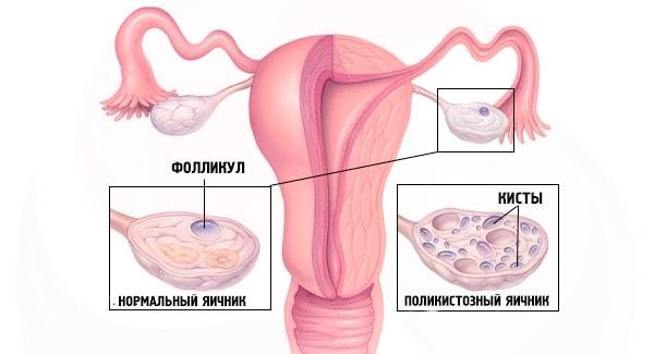 Поликистоз женских половых органов