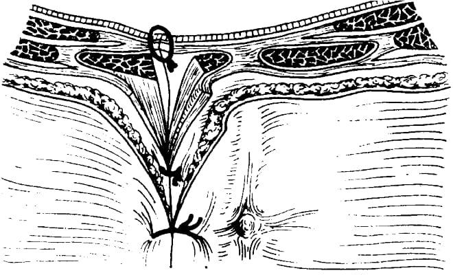 Трансректальная лапаротомия справа