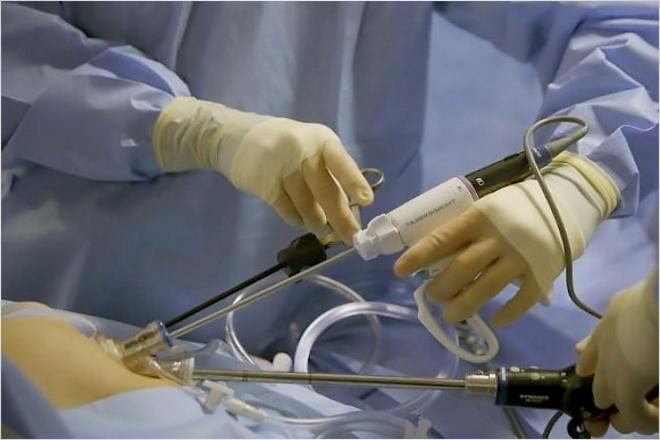 Проведение лапаротомии парных половых органов женщины