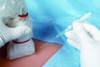 Проведение пункции кисты яичника под УЗИ