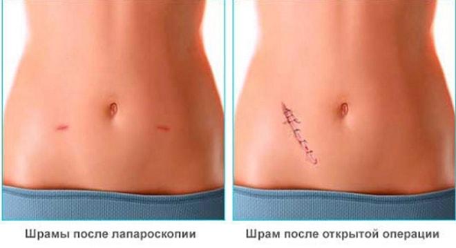 Шрамы после лапароскопии и лапаротомии