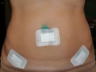 Снятие швово после лапароскопии кисты яичника