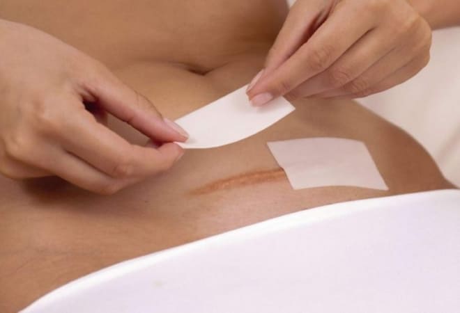 Шрамы после трансректальной лапаротомии