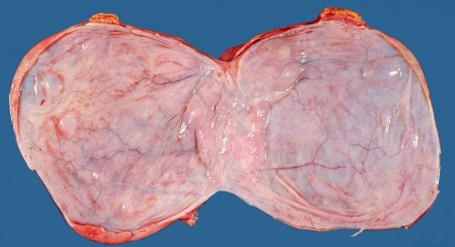 Серозная цистаденома