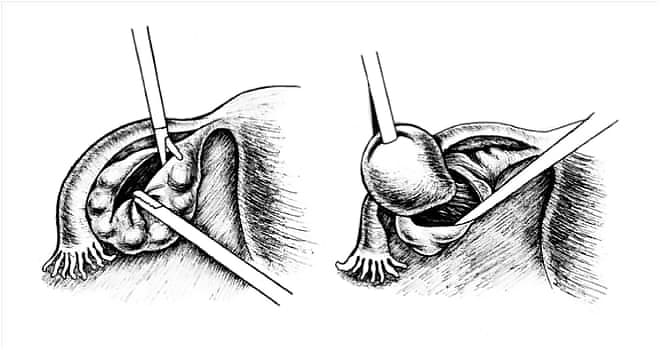 Как проводится цистэктомия яичника лапаротомическим способом