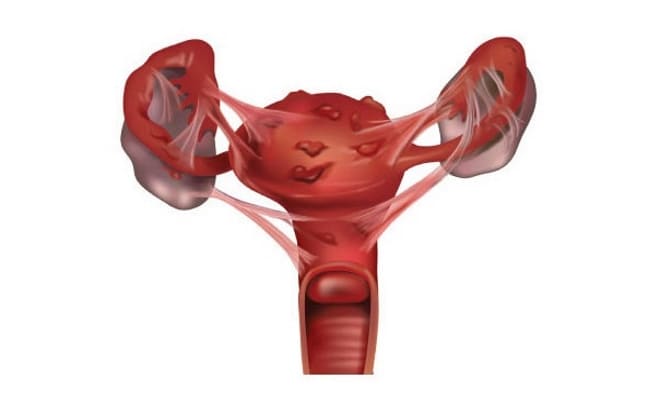 Спайки и туберкулёз яичников