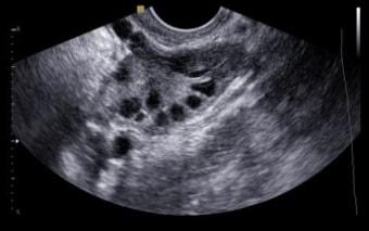 Антральные фолликулы на УЗИ