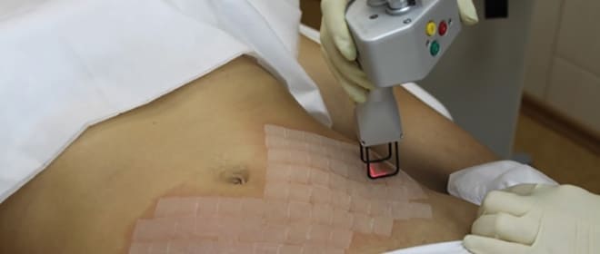 Услуги по удалению шрамов и рубцов в салонах красоты