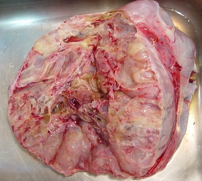 Муцинозная цистаденома яичника