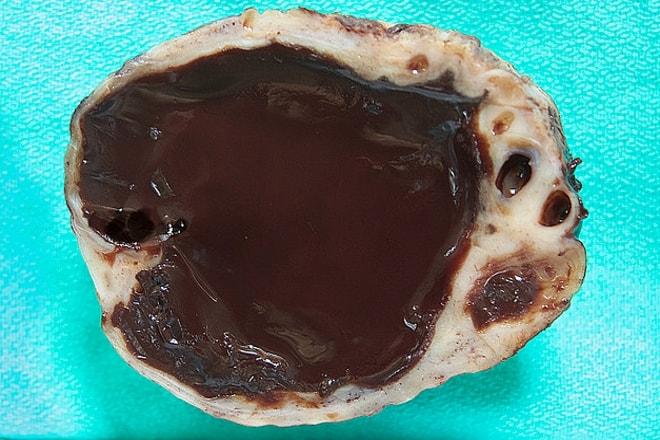 Эндометриоидная киста яичника