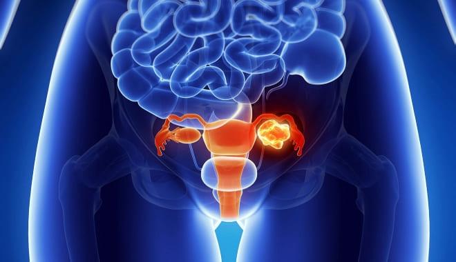 Как выглядит воспаление правого яичника у женщины