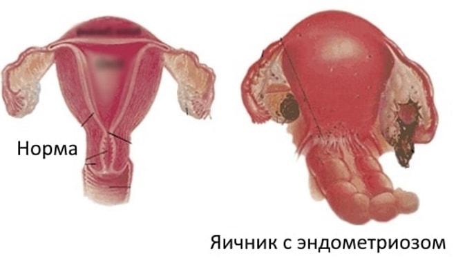 Здоровый яичник и с эндометриозом