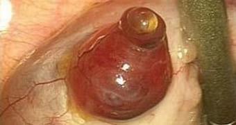 Выход яйцеклетки из фолликула яичника