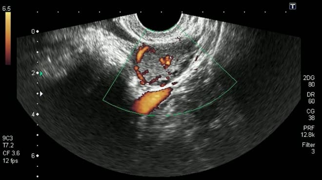 Как выглядит жёлтое тело яичника на УЗИ