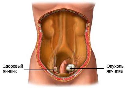 Яичник здоровый и с опухолью