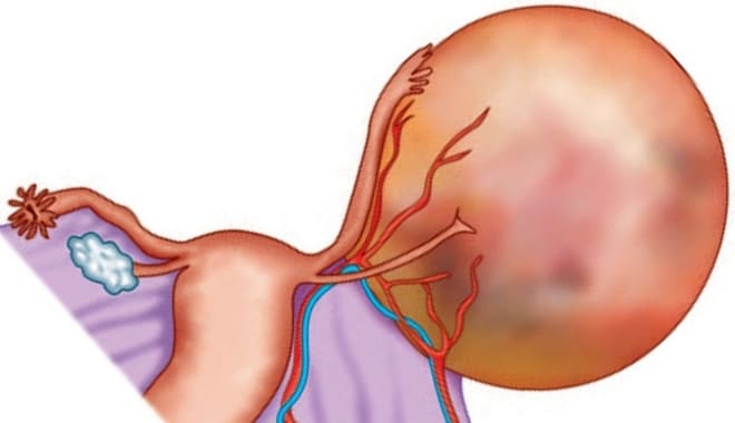 Опухоль яичника у женщины при климаксе