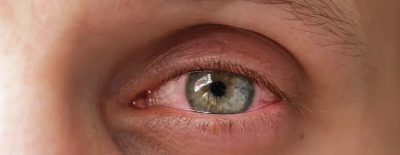 аллергический ринит и конъюнктивит