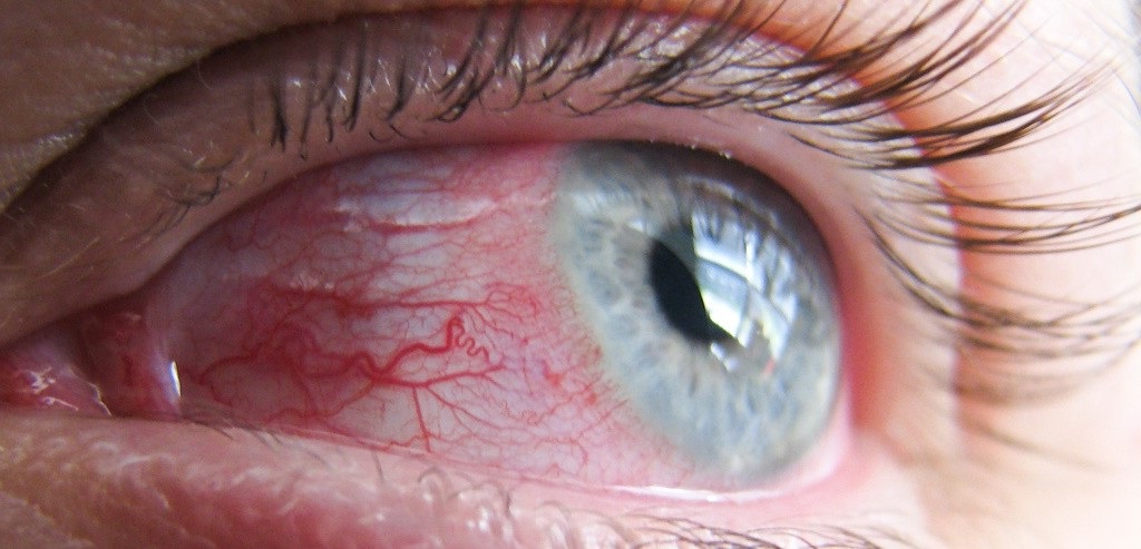 аллергический конъюнктивит симптомы