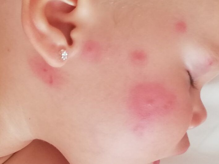 Аллергия на комаров