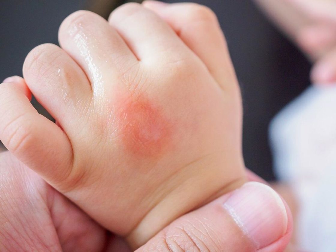 Аллергия на укусы комаров