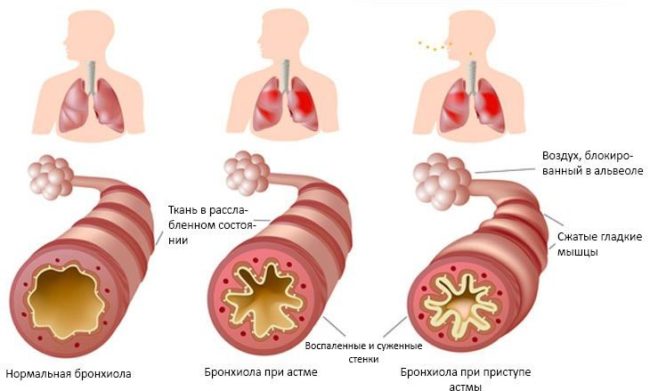Степени бронхиальной астмы
