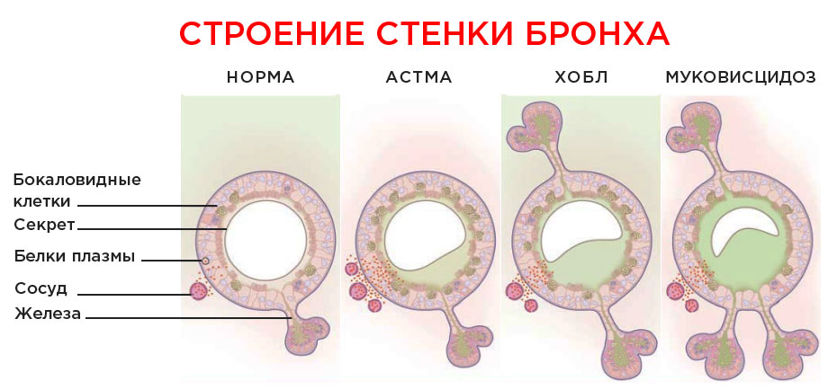 Состояние бронхов при астме