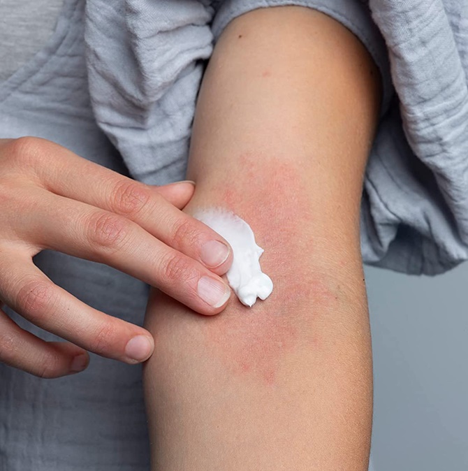 мази и гели от аллергии