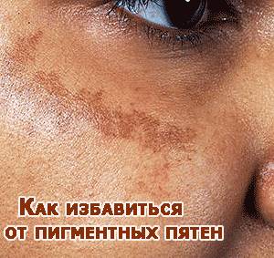 Пигментные пятна