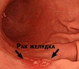 рак желудка